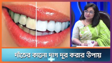 দাঁতের কালো দাগ দূর করার উপায় দাঁতের কালো দাগ দূর করার উপায়